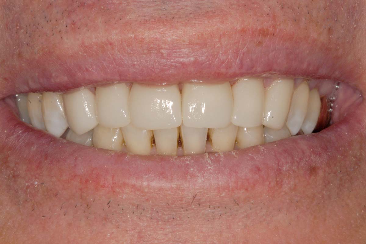 good teeth after photo