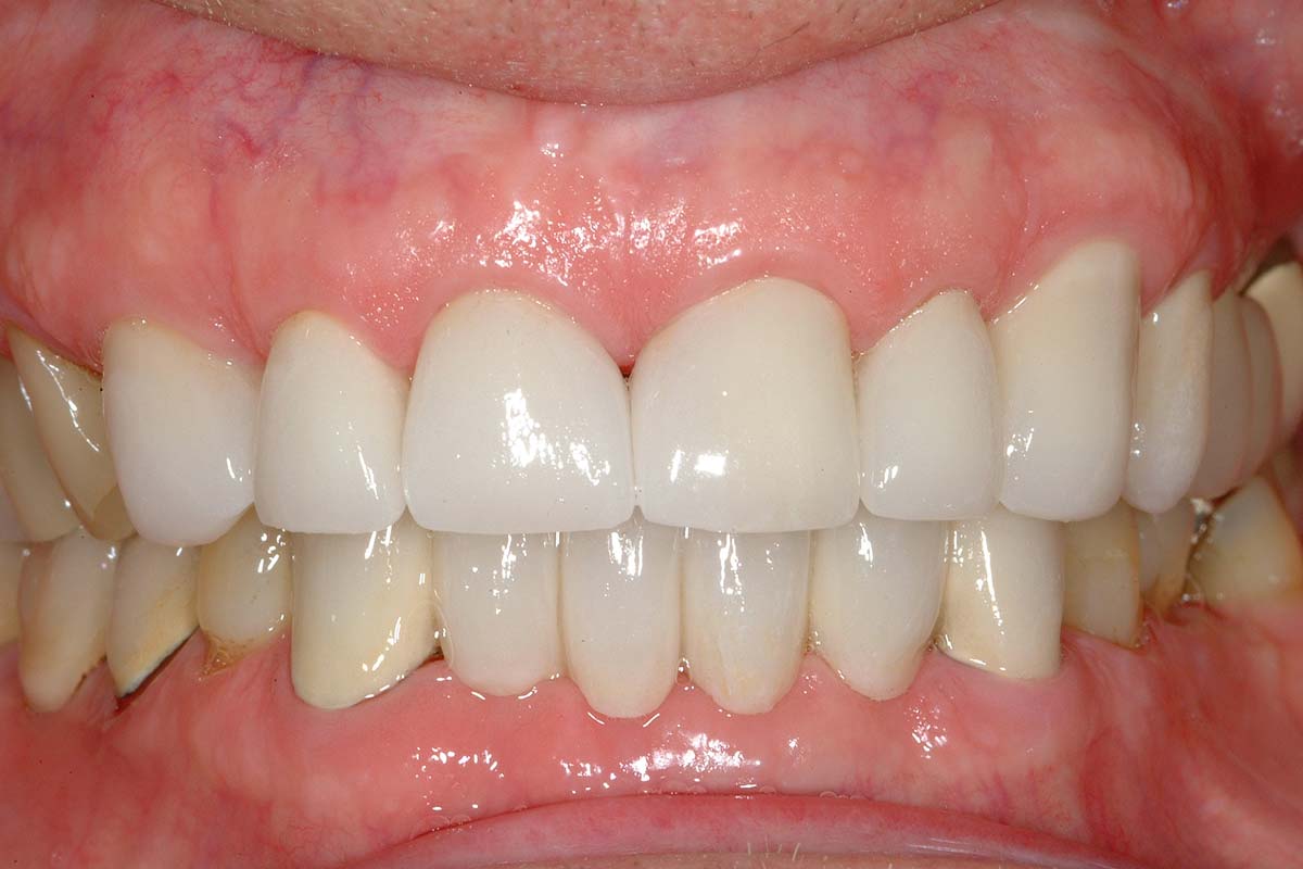 good teeth after photo from Waddell Restorative Dentistry in Germantown, TN.